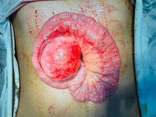 Intraoperative image showing a unilocular cyst within the mesentery, located ~30 cm distal to the duodenojejunal junction.