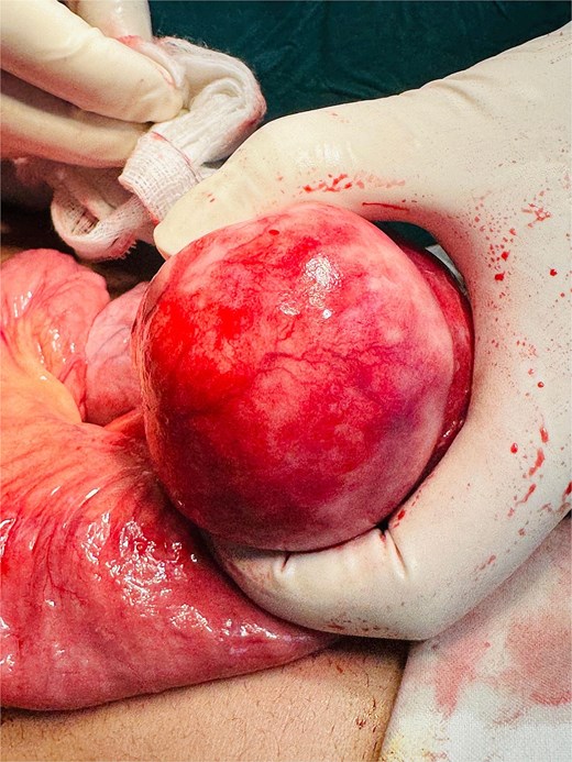 Intraoperative image showing a well-circumscribed, tense, unilocular mesenteric cyst with smooth external surface, arising from the small bowel mesentery ~30 cm distal to the duodenojejunal junction.