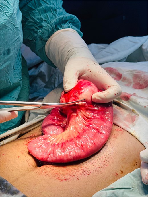 Intraoperative image demonstrating surgical excision of the mesenteric cyst from the small bowel mesentery.