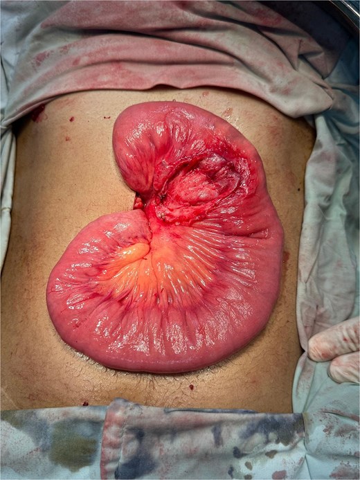 Intraoperative view of the operative field after complete excision of the mesenteric cyst, showing intact surrounding bowel loops without injury.