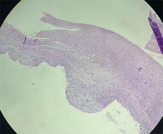 Histopathological section of the excised mesenteric cyst showing focal bland mesothelial lining with papillary budding, chronic inflammatory infiltrate, and underlying fibroblastic stroma, consistent with a chylolymphatic mesenteric cyst.