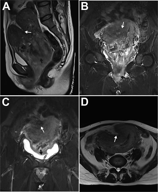 MRI features of subacute uterine inversion secondary to a large uterine myoma. A: Paramedian sagittal T2-weighted turbo spin-echo image showed a lobulated fundal depression (white arrow) and the underlying uterine myoma (black arrow); B: Paramedian sagittal T2-weighted turbo inversion recovery magnitude (TIRM) image demonstrated the myoma prolapsing from the uterine cavity into the vagina (white arrow), with a portion extending through the introitus (black arrow); C: Coronal T1-weighted image revealed the myometrial indentation (white arrow) and the compressed urinary bladder (black arrow); D: Axial T2-weighted turbo spin-echo image showed the myometrial depression (white arrow) on the right anterofundal wall.