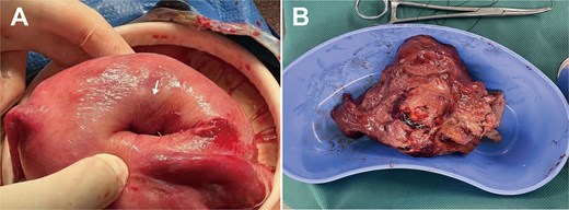 Intraoperative findings during laparotomy for uterine inversion. A: Enlarged uterus with smooth serosa; a 2.5 cm-diameter, 4 cm-deep distinct depression (white arrow) on the right anterofundal wall; B: Surgically enucleated, bisected uterine myoma, showing typical leiomyoma gross features: Dark red color, soft consistency, whorled cut surface.
