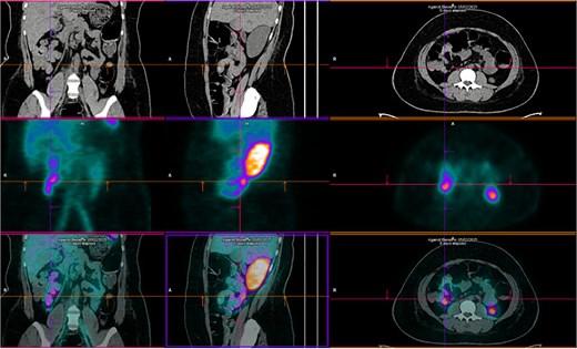 Technetium-labeled red blood cells scintigraphy showing two foci of active bleeding in the mesogastric and hypogastric regions.