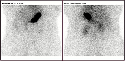 Negative scintigraphy for Meckel’s diverticulum.