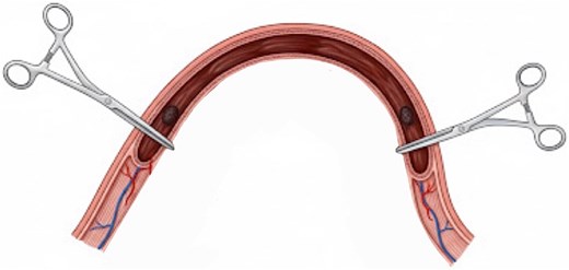 Ilustration of intraoperative isolation of jejunal nodular lesions with clamps; blood reaccumulated only in the isolated segment.