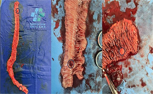 Ressected jejunal specimen with nodular lesions demarcated.