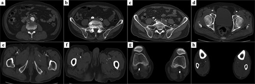 Preoperative CT findings. (a) A 40-mm infrarenal AAA. (b) Complete occlusion of the left common iliac artery. (c) A patent right internal iliac artery with favorable quality. (d) Occlusion from the right external iliac artery to the common femoral artery because of severe calcification. (e) Occlusion of the right superficial femoral artery and a patent profunda femoris artery serving as the target outflow vessel. (f) A patent left profunda femoris artery. (g) Severe calcification of both popliteal arteries. (h) Distal runoff beyond the tibial trifurcation was maintained via collateral flow from the profunda femoris artery.
