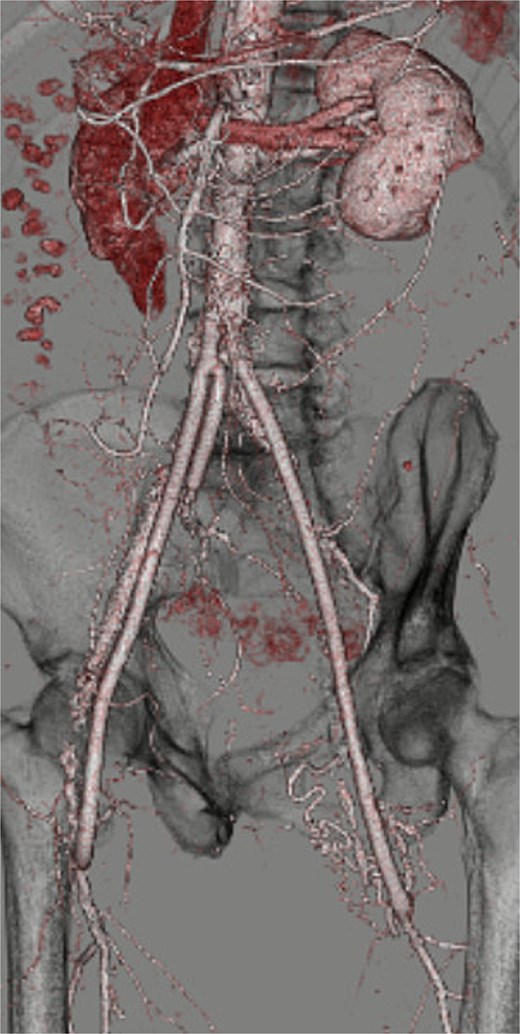 Postoperative three-dimensional CT demonstrating well-reconstructed aorto-profunda and internal iliac bypasses.