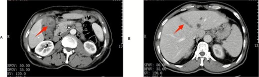 Preoperative imaging. (A) Contrast-enhanced CT scan in the arterial phase demonstrating gallbladder wall thickening with enhancement (arrow). (B) Contrast-enhanced CT in the venous phase showing thrombus formation within the middle hepatic vein (arrowhead).