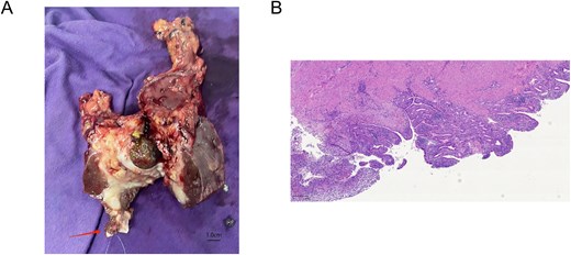 (A) Gross surgical specimen of the gallbladder and adjacent liver tissue, showing the site of thrombus formation in the middle hepatic vein (arrow). (B) Microscopic image showing chronic suppurative cholecystitis (Giemsa stain, ×50).