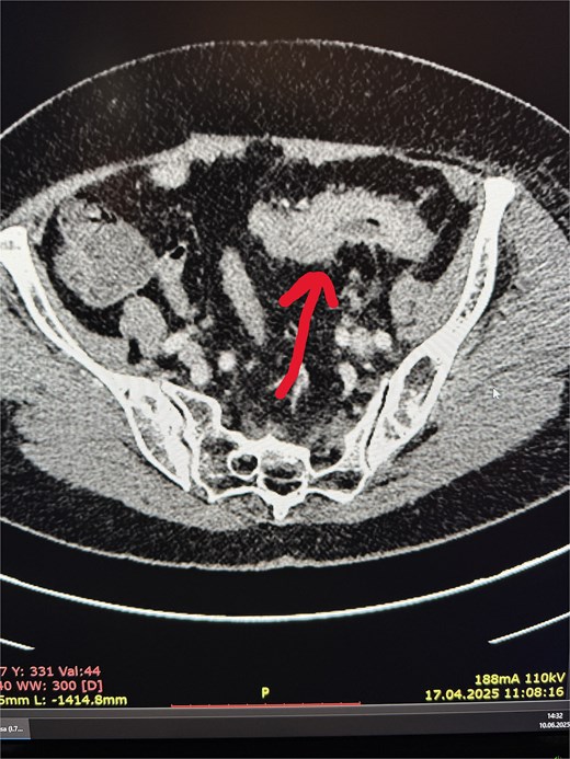 Sigmoid cancer on CT scan.