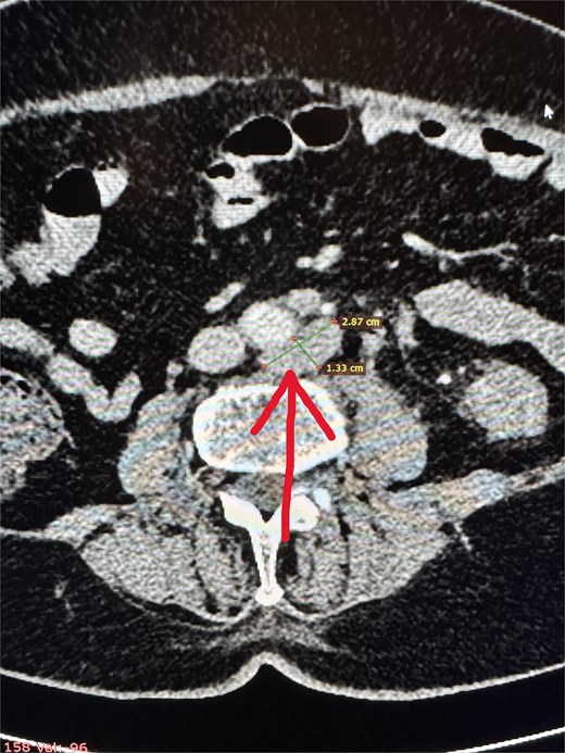 Enlarged para-aortic lymph node.