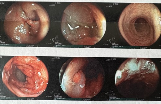 Endoscopic view of colorectal cancer.