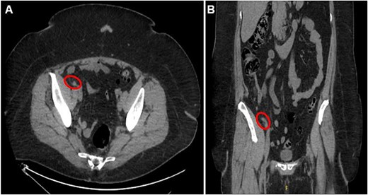Axial (A) and coronal (B) CT abdomen and pelvis images demonstrating minimally thickened appendiceal tip measuring 7.8 mm with minimal surrounding fat stranding and no adjacent free air or fluid collection, indicating uncomplicated appendicitis.