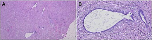 Hematoxylin and eosin (H&E)-stained tissue sections of the appendix showing glandular epithelial structures within the muscularis externa (A) as well as glands and tubules lined by columnar or cuboidal cells with cilia without the presence of endometrial stroma or hemorrhage (B). Original magnification 40× (A) and 200× (B).