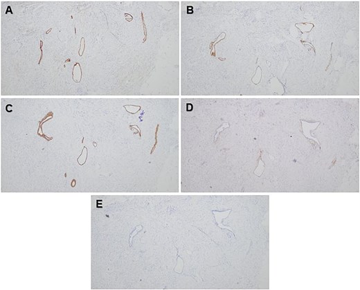 Photomicrographs showing positive epithelial staining with PAX8 (A), ER (B), and CK7 (C) immunohistochemical stains and negative epithelial staining with CD10 (D) and CK20 (E) immunohistochemical stains. Original magnification 40× (A–E).