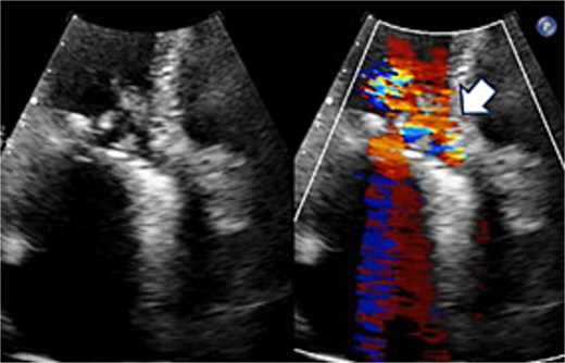 Preoperative transthoracic echocardiography: significant paraventricular leakage was shown with the white arrow.