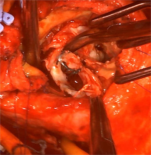 Intraoperative view: the aortotomy extended from the left-noncoronary commissure toward the left atrium.