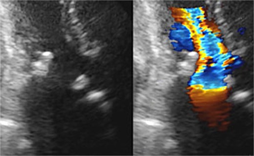 Postoperative transthoracic echocardiography: normal function of both prosthetic valves without dysfunction.
