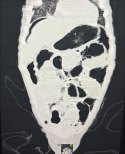 CT abdomen revealed free air under the diaphragm, indicating hollow viscus perforation.