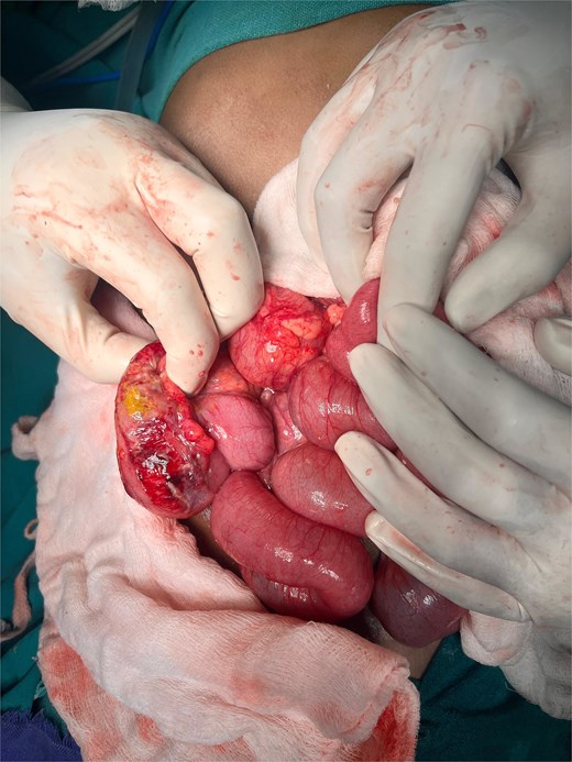 Intraoperative findings show the ileo-cecal region, which is inflamed, edematous, and ischemic, with a solitary cecal perforation and leakage of fecal matter.