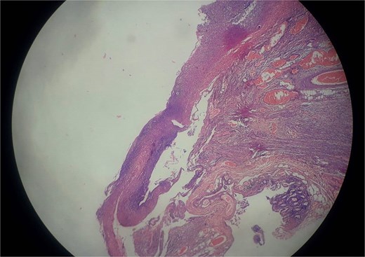 Histopathology revealed acute on chronic non-specific ileitis with typhlitis showing transmural mixed inflammatory infiltrates and reactive lymphoid hyperplasia without granulomas.