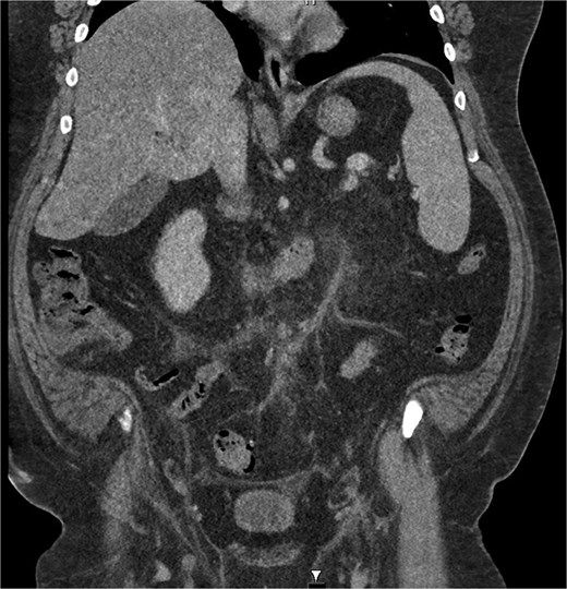 Coronal CT image demonstrating portal venous contrast phase abdomen, with inflammatory fat stranding and wall enhancement of the IMV.