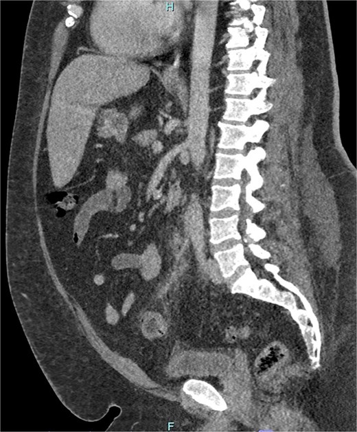 Sagittal CT image demonstrating portal venous contrast phase abdomen, with inflammatory fat stranding and wall enhancement of the IMV and branches.