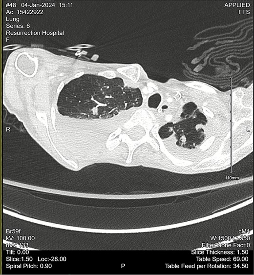 CT chest angiogram with axial cross-section demonstrating bilateral pulmonary nodules and scattered ground-glass lesions in the upper lobes. No signs of embolism in the pulmonary arterial segments. Reduced lung volumes secondary to bilateral pleural effusions are observed.