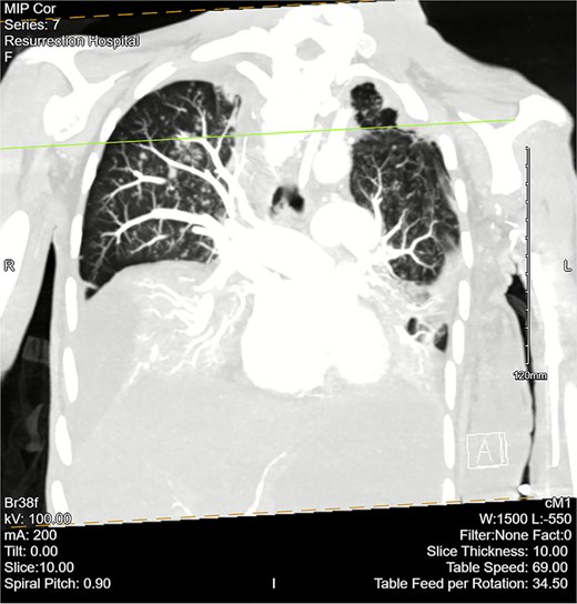 CT chest angiogram with a coronal cross section. Bilateral pleural effusions with atelectasis are observed. Ground-glass opacities with scattered nodules are present in the upper lobes. Lung volumes are reduced. There are no signs of embolism in pulmonary arterial segments.