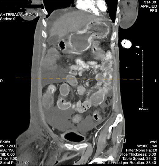 CT angiogram of the abdomen and pelvis—arterial phase with a coronal cross section. Patchy contrast extravasation is observed in the ileocecal region with adjacent distal wall-thickening. Distended loops of small bowel with mesenteric fat stranding are observed. Significant abdominopelvic free fluid is seen, correlating with ascites. Enlarged mesenteric lymph nodes are observed.