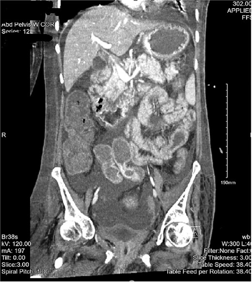 CT of the abdomen and pelvis with a coronal cross-section. Asymmetric wall thickening is observed in the cecum and ascending colon with adjacent fat stranding. Proximal dilation of small bowel loops with mesenteric stranding is also seen. Significant abdominopelvic free fluid is demonstrated. The CT findings correlate with mass versus inflammatory colitis. The read was addended to reflect concerns for cecal mass.