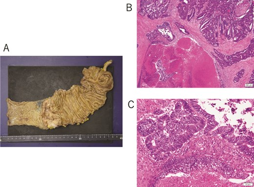 (A) Surgical resected specimen showing a tumor lesion with clear borders and ulceration and a diameter of 65 × 43 mm in the transverse colon. (B, C) Histological findings showing moderately differentiated adenocarcinoma.