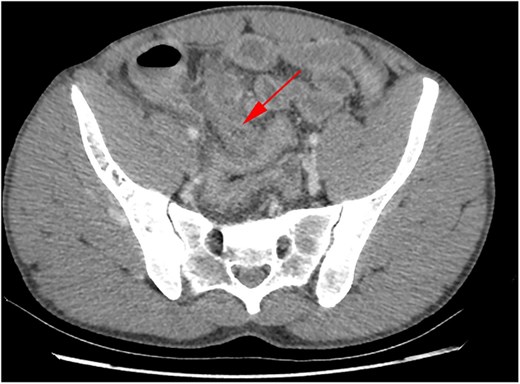 CT abdomen/pelvis axial view demonstrating inflamed appendix.