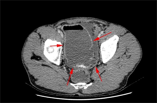 CT abdomen/pelvis axial view demonstrating small bowel diverticulum.
