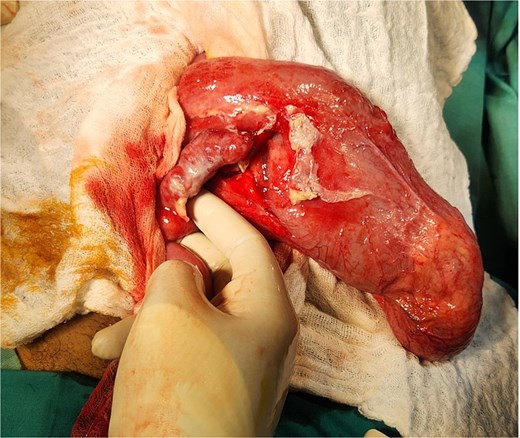Intraoperative picture demonstrating MD and inflamed appendix.
