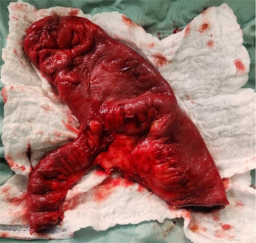 Resected specimen showing Giant MD.