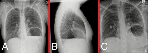 (A) Anteroposterior and (B) lateral view CXRs taken during the patient’s initial presentation, demonstrating effacement of the left hemidiaphragm outline, with a large air-fluid level within the left hemithorax and no evidence of a pneumothorax. (C) Anteroposterior view CXR following urgent NGT insertion for gastric decompression with its tip projecting over the stomach, with associated compressive atelectasis of the left lung.