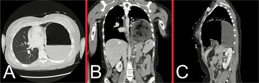 Representative CT images taken during the patient’s initial presentation. (A) Axial, (B) coronal, and (C) sagittal views illustrate a markedly distended stomach with an air-fluid level that is displaced into the left hemithorax, with normal mural enhancement and no evidence of gastric pneumatosis. The left lung is partly collapsed, but there is no evidence of an associated pleural effusion or pneumothorax. The free edge of the ruptured diaphragm is best appreciated on the sagittal view. These findings are consistent with a large, incarcerated left DH, with possible gastric volvulus.