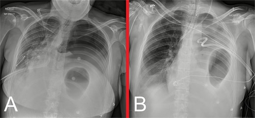 (A) Urgent bedside CXR demonstrating a new, large, left pneumothorax with significant rightward mediastinal shift, consistent with a tension pneumothorax. (B) Anteroposterior CXR following insertion of a left ICC via an anterior approach, showing restoration of the mediastinal structures to the midline, improved aeration of the right lung and near-complete collapse of the left lung. Obliteration of the left hemidiaphragm outline, left hydropneumothorax, and gastric herniation into the left hemithorax are also demonstrated.
