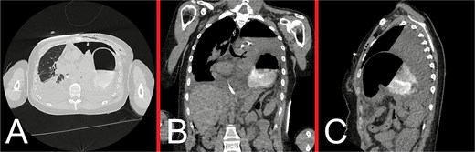Representative CT images taken following decompression of the left tension pneumothorax with ICC insertion. (A) Axial, (B) coronal, and (C) sagittal views demonstrate a persistent left DH with associated gastrothorax. Since the CT obtained on initial presentation, there has been interval evolution of a left hydropneumothorax as evidenced by an air-fluid level outside the boundaries of the herniated stomach, and near-complete collapse of the underlying left lung. The tip of the pigtail ICC is located medially within the left hemithorax. These findings are suggestive of gastric strangulation and perforation arising as a secondary complication of the DH.