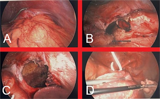 (A) Intraabdominal view of the DH upon initial laparoscopic entry into the abdomen. (B) Appearance of the stomach following dissection of the hernia sac and reduction of the stomach into the abdominal cavity, revealing a 3 cm perforation in the gastric fundus. (C) Final appearance of the large diaphragmatic defect prior to definitive repair. (D) Intrathoracic view of left hemithorax, demonstrating contamination with gastric contents, fibrin deposition on the left lung and the previously inserted ICC.