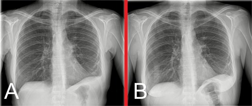 Progress anteroposterior view CXRs taken at (A) 3 months and (B) 7 months postoperatively, showing persistent, but stable, left hemidiaphragm elevation with associated generalized volume loss of the left lung, but no evidence of hernia recurrence.