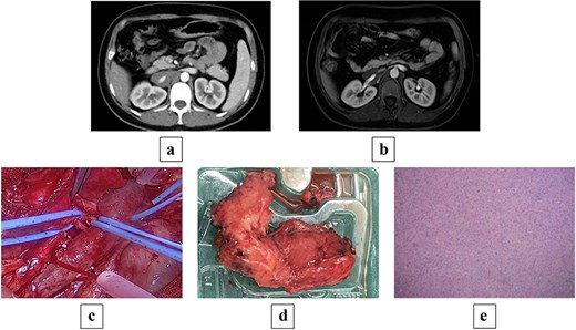 (a) Preoperative contrast-enhanced CT shows a mass-like soft tissue density shadow at the right renal hilum and adjacent to the IVC, with uniform density accompanied by punctate dense shadows at the posterior margin, measuring ~24 × 34 × 70 mm, encasing the IVC and right renal artery and vein, with partially unclear boundaries at the horizontal portion of the duodenum. (b) Preoperative MRI shows a mass-like soft tissue signal shadow at the right renal hilum and adjacent to the IVC; post-contrast scan reveals mild enhancement at the edges of the lesion, which encases the IVC and right renal artery and vein. (c) Intraoperative view of the tumor encasing the renal artery and IVC. (d) Gross pathology specimen of the resected irregular tissue fragment (8 × 6 × 2.5 cm) with gray–white cut surface, firm consistency, and attached portion of adrenal gland (2 × 1.5 × 0.3 cm). (e) Histopathological micrograph revealing mature ganglion cells with large, round nuclei and prominent nucleoli (hematoxylin and eosin stain; original magnification ×200).