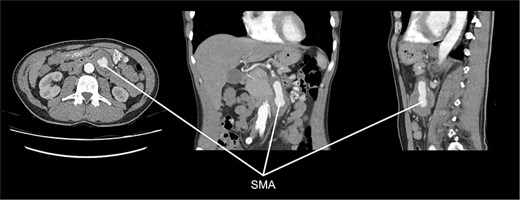 CT angiography showing an aneurysm in the SMA.