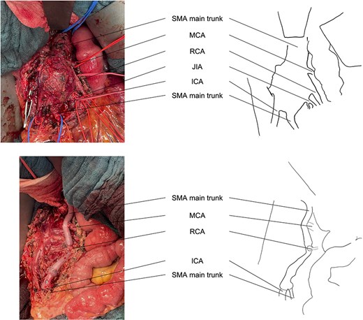 Intraoperative view before and after resection of the aneurysm and reconstruction of the SMA branches. ICA, ileocolic artery; JIA, jejunoileal artery; MCA, middle colic artery; RCA, right colic artery.