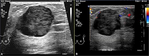 Ultrasound of the left breast. (A) Grayscale and (B) color Doppler images demonstrate a vertically oriented, microlobulated, heterogeneously hypoechoic mass at the 3 o’clock position in the distal left breast, showing peripheral rim vascularity.