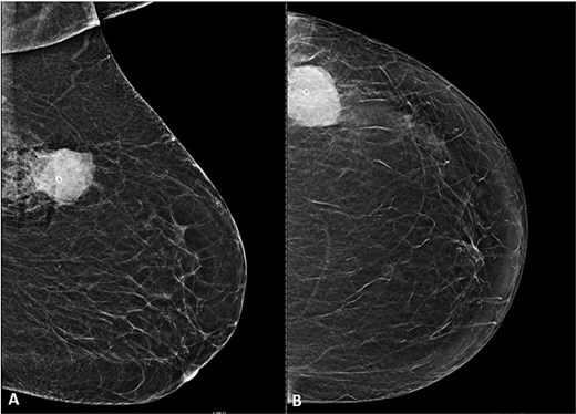 Mammogram of the left breast. (A) Craniocaudal (CC) and (B) mediolateral oblique (MLO) views demonstrate a high-density, microlobulated mass containing a post-biopsy clip with surrounding post-procedural changes.