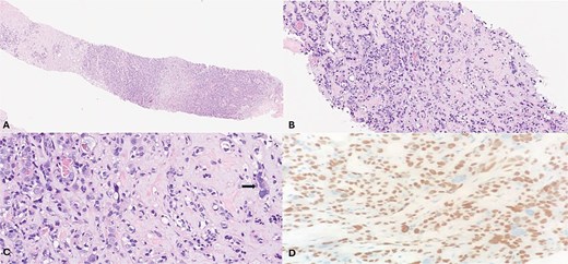 (A) (Hematoxylin & eosin (H&E), 2×) low-power view shows distinct neoplasm with infiltrating tumor cells set in a fibromyxoid stroma. (B) & (C) (H&E, 10×, 20×) show a biphasic neoplastic pattern composed of small, compressed tubules lined by two distinct cell populations: Inner round luminal cells and outer polygonal-to-spindled cells with clear cytoplasm. Occasional atypical cells are also noted (arrow). D P63 immunohistochemistry (20×) highlights the prominent myoepithelial cells and focally the atypical cells.